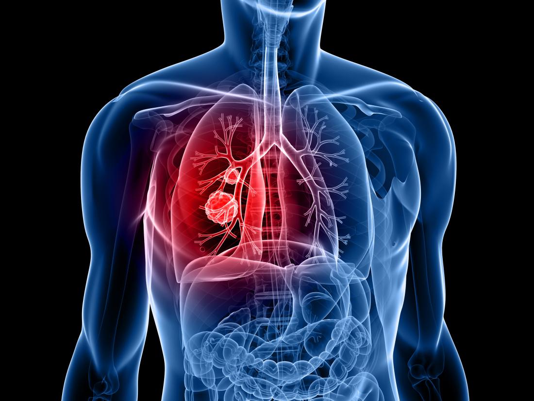 What Is Lung Cancer